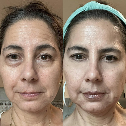 Red Light + EMS Under-Eye Therapy