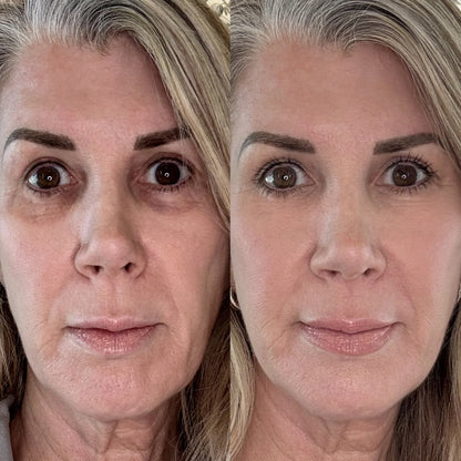 Red Light + EMS Under-Eye Therapy