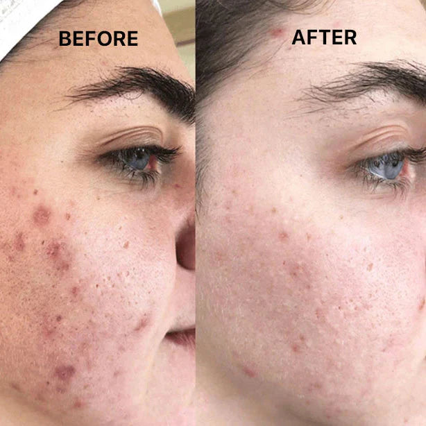 Fibroblast Plasma Pen | Skin Tag and Mole Removal