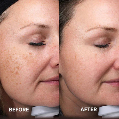 Fibroblast Plasma Pen | Skin Tag and Mole Removal