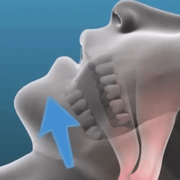 Anti Snoring Mouthpiece